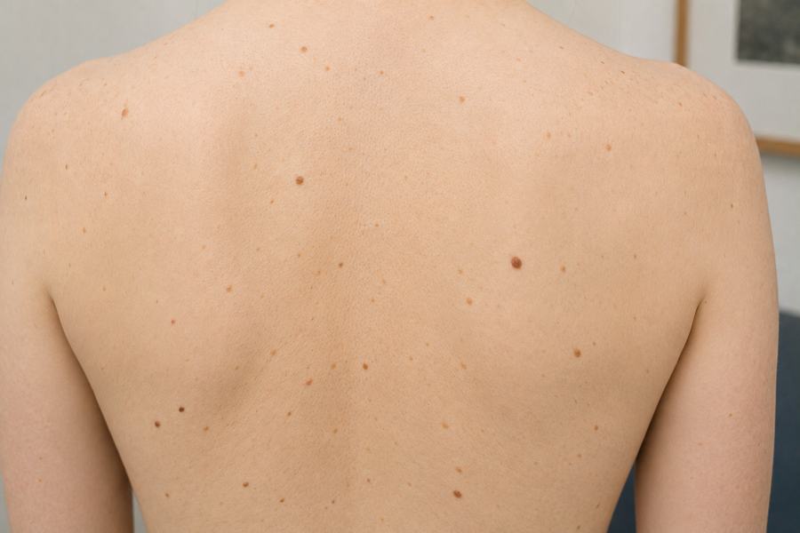 Verändertes Muttermal – Hautmedizin Westend